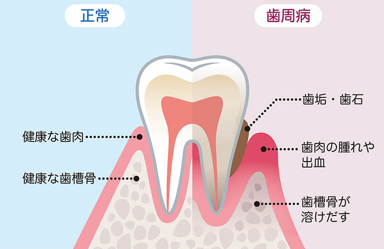 歯の正常な状態と歯周病の比較イラスト