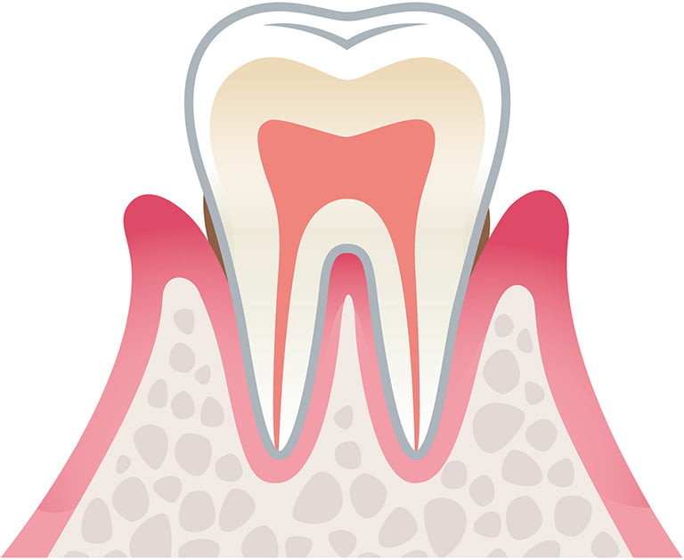 軽度歯周病のイラスト