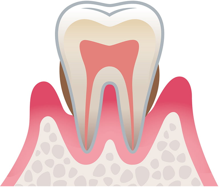 中度歯周病のイラスト