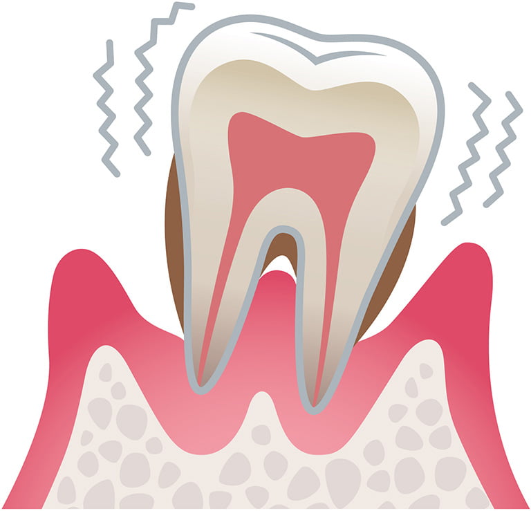 重度歯周病のイラスト